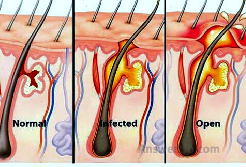 A boil, also referred to as a skin abscess, is a localized infection deep in the skin.