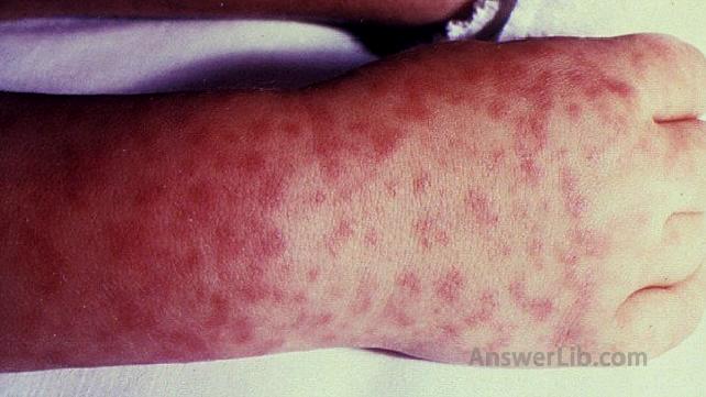 Rocky Mountain Spotted Fever: Pictures and Long-Term Effects